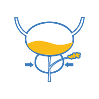 TURP (Prostatectomy)